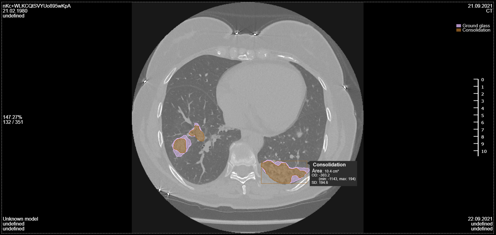 Consolidation analysis