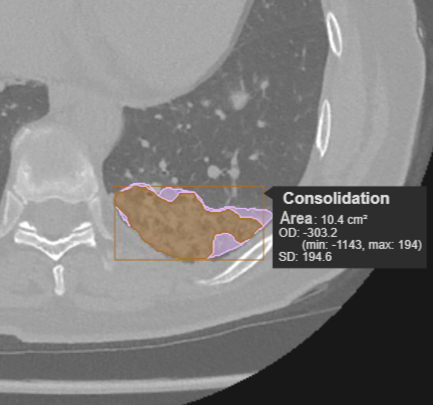 AI-Powered Lung Diagnostics